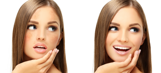 5 Proven and Natural Ingredients to Treat Hyperpigmentation —And What to Avoid